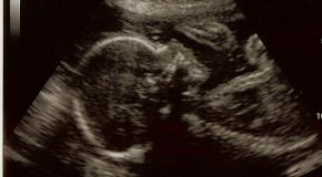 Wrongful Life~Would You Abort Your Baby Under Special Circumstances