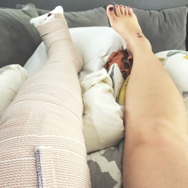 broken leg bridesmaid the fall heard the the about motherhood broken leg bridesmaid the fall heard the the about motherhood